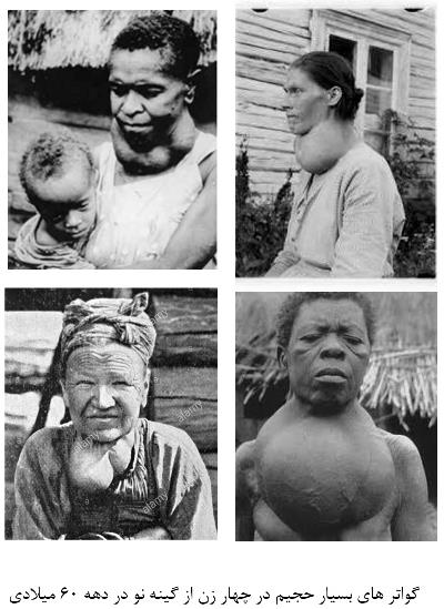گواتر های بسیار حجیم در چهار زن از گینه نو در دهه 60 میلادی