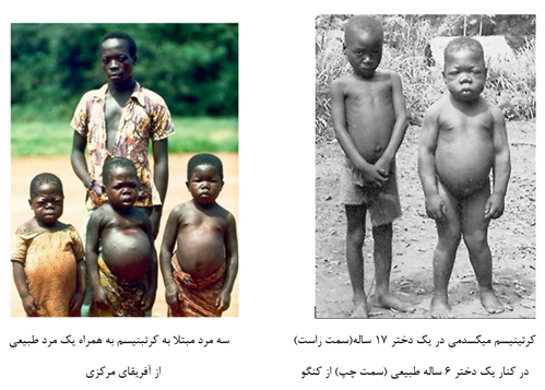 کرتینیسم میکسدمی در یک دختر 17 ساله(سمت راست)سه مرد مبتلا به کرتبنیسم به همراه یک مرد طبیعی در کنار یک دختر 6 ساله طبیعی (سمت چپ) از کنگواز آفریقای مرکزی